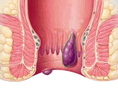 嵌顿痔是怎么回事