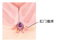 肛门瘙痒有哪些危害