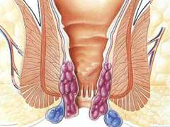 治疗外痔疮方法