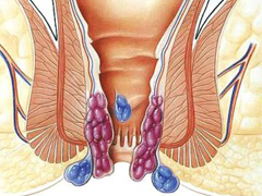 哪些是外痔和内痔区别
