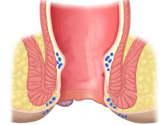 外痔的症状