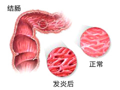 得了急性肠炎有什么影响