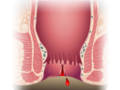 肛门出血的症状及原因
