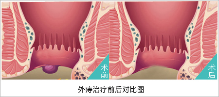 从哪些方面能看出外痔