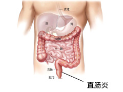 直肠炎