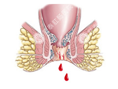 拉屎拉出血是什么原因