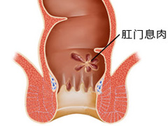 患了直肠炎该怎么办？