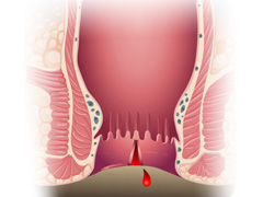 肛裂怎么办