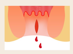 大便后肛门出血怎么治疗