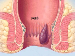 内痔疮的危害有哪些