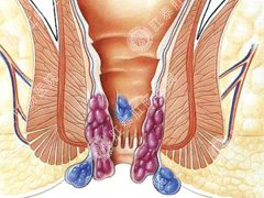 痔疮更有效的治疗方法