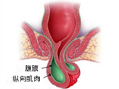 脱肛的更新治疗方法