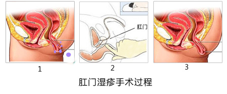 肛门湿疹是什么病